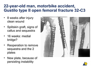 22-year-old man, motorbike accident,
Gustilo type II open femoral fracture 32-C3
• 8 weeks after injury
clean wound
• Splitskin graft, signs of
callus and sequestra
• 16 weeks: medial
bridge?
• Reoperation to remove
sequestra and the 2
plates
• New plate, because of
persisting instability
 