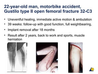 22-year-old man, motorbike accident,
Gustilo type II open femoral fracture 32-C3
• Uneventful healing, immediate active motion & ambulation
• 39 weeks: follow-up with good function, full weightbearing,
• Implant removal after 18 months
• Result after 2 years, back to work and sports, muscle
herniation
 