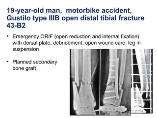 19-year-old man, motorbike accident,
Gustilo type IIIB open distal tibial fracture
43-B2
• Emergency ORIF (open reduction and internal fixation)
with dorsal plate, debridement, open wound care, leg in
suspension
• Planned secondary
bone graft
 