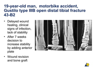 19-year-old man, motorbike accident,
Gustilo type IIIB open distal tibial fracture
43-B2
• Delayed wound
healing, clinical
signs of infection,
lack of stability
• After 7 weeks
decision to
increase stability
by adding anterior
plate
• Wound revision
and bone graft
 