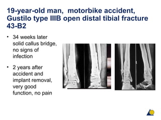 19-year-old man, motorbike accident,
Gustilo type IIIB open distal tibial fracture
43-B2
• 34 weeks later
solid callus bridge,
no signs of
infection
• 2 years after
accident and
implant removal,
very good
function, no pain
 