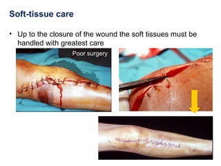 Soft-tissue care
• Up to the closure of the wound the soft tissues must be
handled with greatest care
Poor surgery
 