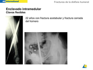 Fracturas de la diáfisis humeral
Enclavado intramedular
Clavos flexibles
22 años con fractura acetabular y fractura cerrada
del húmero
 