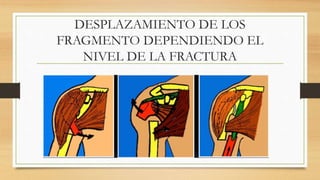DESPLAZAMIENTO DE LOS
FRAGMENTO DEPENDIENDO EL
NIVEL DE LA FRACTURA
 