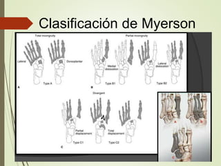 Fx lisfranc y 5 mtt jorge renteros | PPTX