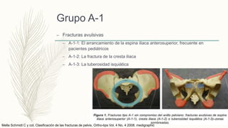 Grupo A-1
– Fracturas avulsivas
– A-1-1: El arrancamiento de la espina iliaca anterosuperior, frecuente en
pacientes pediátricos
– A-1-2: La fractura de la cresta iliaca
– A-1-3: La tuberosidad isquiática
Mella Schmidt C y col. Clasificación de las fracturas de pelvis. Ortho-tips Vol. 4 No. 4 2008. medigraphic
 