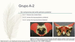 Grupo A-2
– Sin compromiso del anillo pelviano posterior
– A-2-1: fractura de cresta iliaca
– A-2-2: ramas ilio-isquiopubiana unilateral
– A-2-3: ramas ilio-isquiopubiana bilateral
Mella Schmidt C y col. Clasificación de las fracturas de pelvis. Ortho-tips Vol. 4 No. 4 2008. medigraphic
 