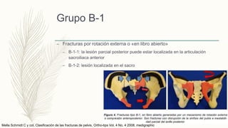 Grupo B-1
– Fracturas por rotación externa o «en libro abierto»
– B-1-1: la lesión parcial posterior puede estar localizada en la articulación
sacroiliaca anterior
– B-1-2: lesión localizada en el sacro
Mella Schmidt C y col. Clasificación de las fracturas de pelvis. Ortho-tips Vol. 4 No. 4 2008. medigraphic
 