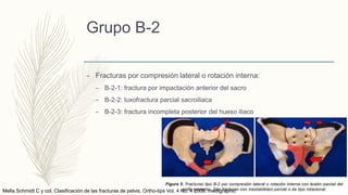 Grupo B-2
– Fracturas por compresión lateral o rotación interna:
– B-2-1: fractura por impactación anterior del sacro
– B-2-2: luxofractura parcial sacroiliaca
– B-2-3: fractura incompleta posterior del hueso iliaco
Mella Schmidt C y col. Clasificación de las fracturas de pelvis. Ortho-tips Vol. 4 No. 4 2008. medigraphic
 