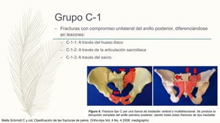 Grupo C-1
– Fracturas con compromiso unilateral del anillo posterior, diferenciándose
en lesiones:
– C-1-1: A través del hueso iliaco
– C-1-2: A través de la articulación sacroiliaca
– C-1-3: A través del sacro.
Mella Schmidt C y col. Clasificación de las fracturas de pelvis. Ortho-tips Vol. 4 No. 4 2008. medigraphic
 