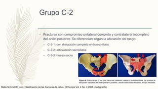 Grupo C-2
– Fracturas con compromiso unilateral completo y contralateral incompleto
del anillo posterior. Se diferencian según la ubicación del rasgo:
– C-2-1: con disrupción completa en hueso iliaco
– C-2-2: articulación sacroiliaca
– C-2-3: hueso sacro
Mella Schmidt C y col. Clasificación de las fracturas de pelvis. Ortho-tips Vol. 4 No. 4 2008. medigraphic
 