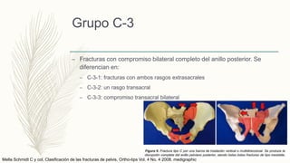 Grupo C-3
– Fracturas con compromiso bilateral completo del anillo posterior. Se
diferencian en:
– C-3-1: fracturas con ambos rasgos extrasacrales
– C-3-2: un rasgo transacral
– C-3-3: compromiso transacral bilateral
Mella Schmidt C y col. Clasificación de las fracturas de pelvis. Ortho-tips Vol. 4 No. 4 2008. medigraphic
 