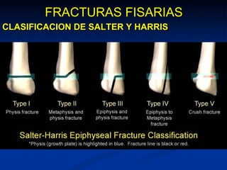 FRACTURAS FISARIAS CLASIFICACION DE SALTER Y HARRIS 