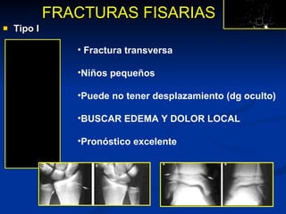 Tipo I FRACTURAS FISARIAS Fractura transversa Niños pequeños Puede no tener desplazamiento (dg oculto) BUSCAR EDEMA Y DOLOR LOCAL Pronóstico excelente 