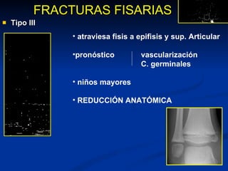 Tipo III FRACTURAS FISARIAS atraviesa fisis a epifisis y sup. Articular pronóstico vascularización C. germinales niños mayores REDUCCIÓN ANATÓMICA 