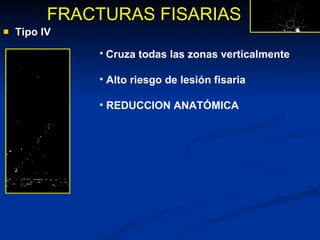 Tipo IV FRACTURAS FISARIAS Cruza todas las zonas verticalmente Alto riesgo de lesión fisaria REDUCCION ANATÓMICA 
