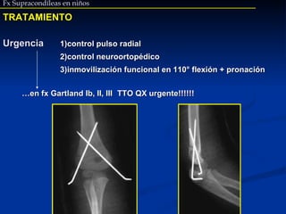 Fx Supracondíleas en niños TRATAMIENTO Urgencia 1)control pulso radial 2)control neuroortopédico   3)inmovilización funcional en 110° flexión + pronación  … en fx Gartland Ib, II, III TTO QX urgente!!!!!! 