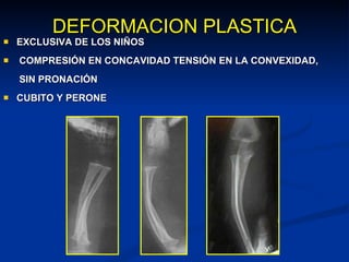 DEFORMACION PLASTICA EXCLUSIVA DE LOS NIÑOS COMPRESIÓN EN CONCAVIDAD TENSIÓN EN LA CONVEXIDAD,   SIN PRONACIÓN  CUBITO Y PERONE 
