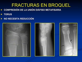 FRACTURAS EN BROQUEL COMPRESIÓN DE LA UNIÓN DIÁFISO METAFISARIA  TORUS NO NECESITA REDUCCIÓN 