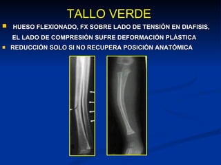 TALLO VERDE HUESO FLEXIONADO, FX SOBRE LADO DE TENSIÓN EN DIAFISIS,   EL LADO DE COMPRESIÓN SUFRE DEFORMACIÓN PLÁSTICA REDUCCIÓN SOLO SI NO RECUPERA POSICIÓN ANATÓMICA 