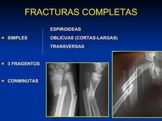 FRACTURAS COMPLETAS ESPIROIDEAS SIMPLES OBLICUAS (CORTAS-LARGAS) TRANSVERSAS 3 FRAGENTOS CONMINUTAS 