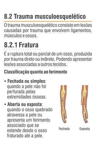 8.2 Trauma musculoesquelético
Otraumamusculoesqueléticoconsisteemlesões
causadas por trauma que envolvem ligamentos,
músculoseossos.
8.2.1Fratura
É a ruptura total ou parcial de um osso, produzida
por trauma direto ou indireto. Podendo apresentar
lesõesassociadasaoutrostecidos.
Classificação quanto aoferimento
Ÿ
Fechada ou simples:
quando a pele não foi
perfurada pelas
extremidades ósseas.
Ÿ
Aberta ou exposta:
quando o osso quebrado
atravessa a pele ou
apresenta um ferimento
associado que se
estende desde o osso
fraturado até a pele.
Fechada Exposta
 