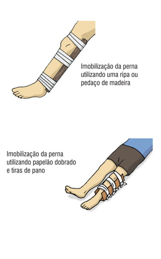 Imobilização da perna
utilizando uma ripa ou
pedaço de madeira
Imobilização da perna
utilizando papelão dobrado
e tiras de pano
 
