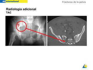 Fracturas de la pelvis
?
Radiología adicional
TAC
 