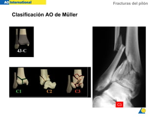 Fx pilon tibial | PPT