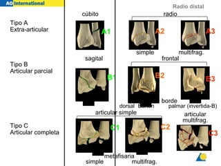 Radio distal
Tipo A
Extra-articular
Tipo B
Articular parcial
A1 A2 A3
B1 B3
B2
sagital frontal
multifrag.
simple
borde
palmar (invertida-B))
dorsal (Barton)
C1 C2
cúbito radio
metafisaria
simple multifrag.
articular simple articular
multifrag.
C3
Tipo C
Articular completa
 