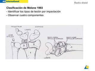 Radio distal
Clasificación de Melone 1993
- Identificar los tipos de lesión por impactación
- Observar cuatro componentes
 