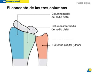 Radio distal
El concepto de las tres columnas
Rikli, Regazzoni
J Bone Joint Surg 1996
Columna radial
del radio distal
Columna intermedia
del radio distal
Columna cubital (ulnar)
 
