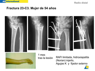 Radio distal
RAFI limitada, hidroxiapatita
(Norian) injerto,
Agujas K y fijador externo
Fractura 23-C3. Mujer de 54 años
1 mes
tras la lesión
 