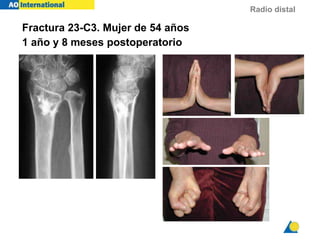 Radio distal
Fractura 23-C3. Mujer de 54 años
1 año y 8 meses postoperatorio
 