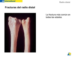 Radio distal
Fracturas del radio distal
La fractura más común en
todas las edades
 