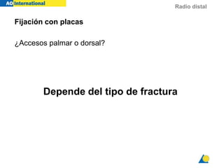 Radio distal
Fijación con placas
¿Accesos palmar o dorsal?
Depende del tipo de fractura
 
