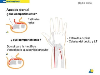 Radio distal
Acceso dorsal
¿qué compartimiento?
¿qué compartimiento?
Estiloides
radial
Dorsal para la metáfisis
Ventral para la superficie articular
- Estiloides cubital
- Cabeza del cúbito y LT
 