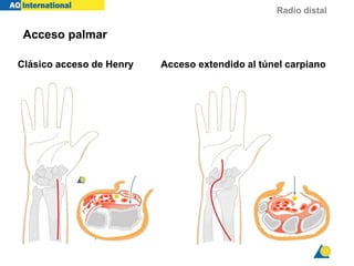 Radio distal
Acceso palmar
Clásico acceso de Henry Acceso extendido al túnel carpiano
 
