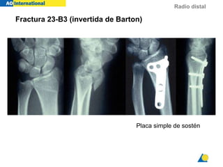 Radio distal
Fractura 23-B3 (invertida de Barton)
Placa simple de sostén
 