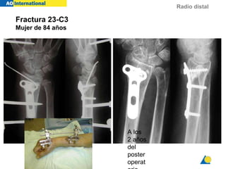 Radio distal
Fractura 23-C3
Mujer de 84 años
A los
2 años
del
poster
operat
 