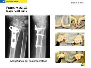 Radio distal
TH 84y f
2y 1m
Fractura 23-C3
Mujer de 84 años
A los 2 años del posteroperatorio
 