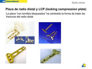 Radio distal
Placa de radio distal y LCP (locking compression plate)
La placa “con tornillos bloqueados” ha cambiado la forma de tratar las
fracturas del radio distal
 