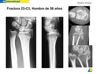 Radio distal
Fractura 23-C3, Hombre de 58 años
 