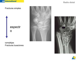 Radio distal
Fracturas simples
complejas
Fracturas luxaciones
espectr
o
 