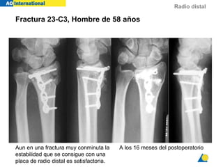 Radio distal
Aun en una fractura muy conminuta la
estabilidad que se consigue con una
placa de radio distal es satisfactoria.
A los 16 meses del postoperatorio
Fractura 23-C3, Hombre de 58 años
 