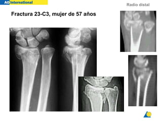 Radio distal
KF 57y f
Fractura 23-C3, mujer de 57 años
 