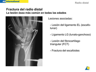Radio distal
Fractura del radio distal
La lesión ósea más común en todas las edades
Lesiones asociadas:
- Lesión del ligamento EL (escafo-
lunar)
- Ligamento LG (lunato-ganchoso)
i
- Lesión del fibrocartílago
triangular (FCT)
- Fractura del escafoides
 