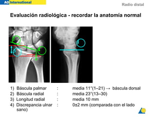 Radio distal
Evaluación radiológica - recordar la anatomía normal
1) Báscula palmar : media 11°(1–21) → báscula dorsal
2) Báscula radial : media 23°(13–30)
3) Longitud radial : media 10 mm
4) Discrepancia ulnar : 0±2 mm (comparada con el lado
sano)
1
2
3 4
 