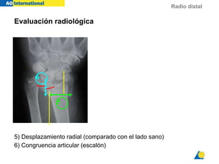 Radio distal
Evaluación radiológica
5) Desplazamiento radial (comparado con el lado sano)
6) Congruencia articular (escalón)
5
6
 