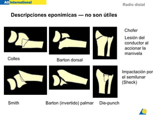 Radio distal
Descripciones eponímicas — no son útiles
Colles Barton dorsal
Chofer
Lesión del
conductor al
accionar la
manivela
Smith Barton (invertido) palmar Die-punch
Impactación por
el semilunar
(Sheck)
 
